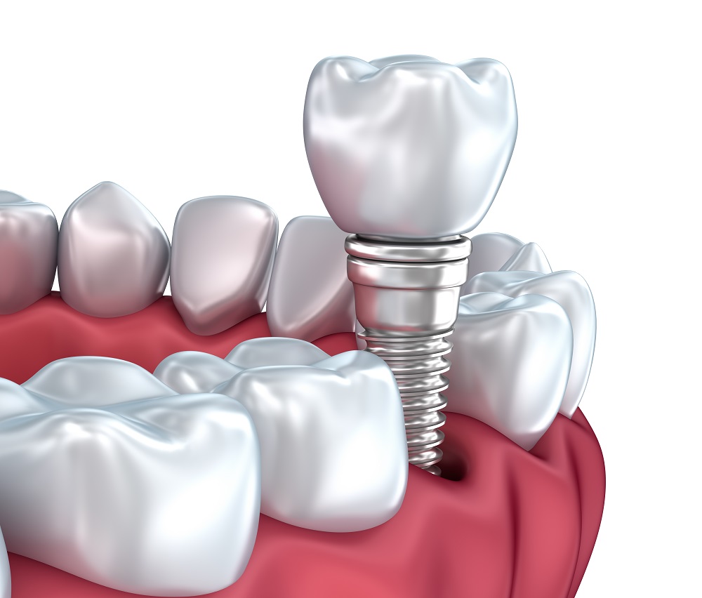 implant dentaire rosemont